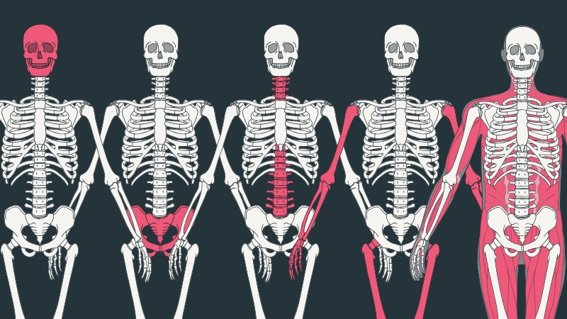Stronger Bones, Stronger Canada: Confronting Osteoporosis Together